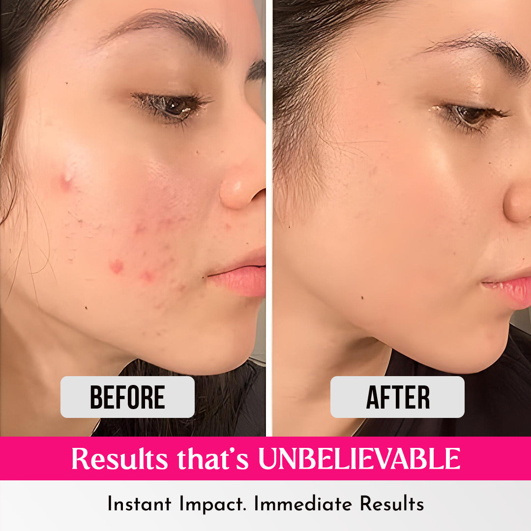 Korea' Hydrocolloid Acne Pimple Patch Absorbs Oil, Prevents Acne | Waterproof Patches | For Acne, Acne Marks, Acne Prone Skin | Salicolloid™ Technology